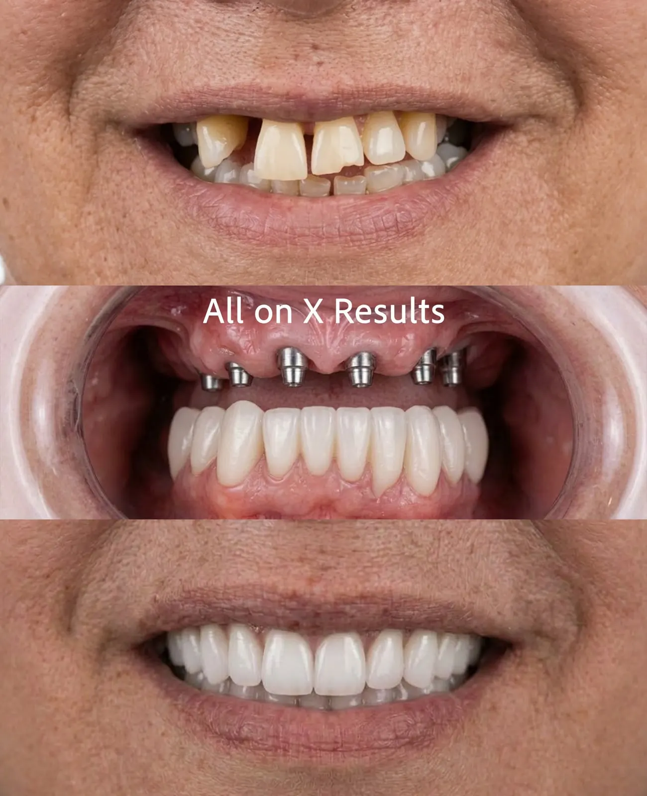 Before and after All-on-X fixed arch on dental implants, Xiluet patient, Miami
