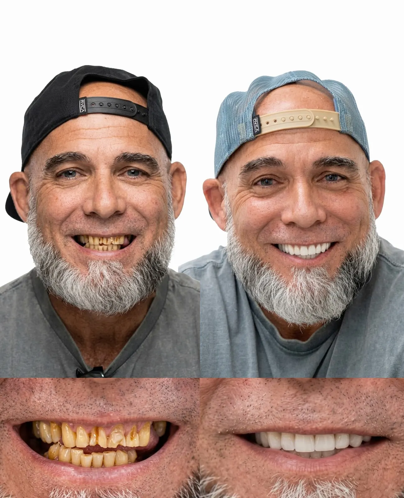 Before and after smile restoration with porcelain crowns and veneers, Xiluet patient, Miami