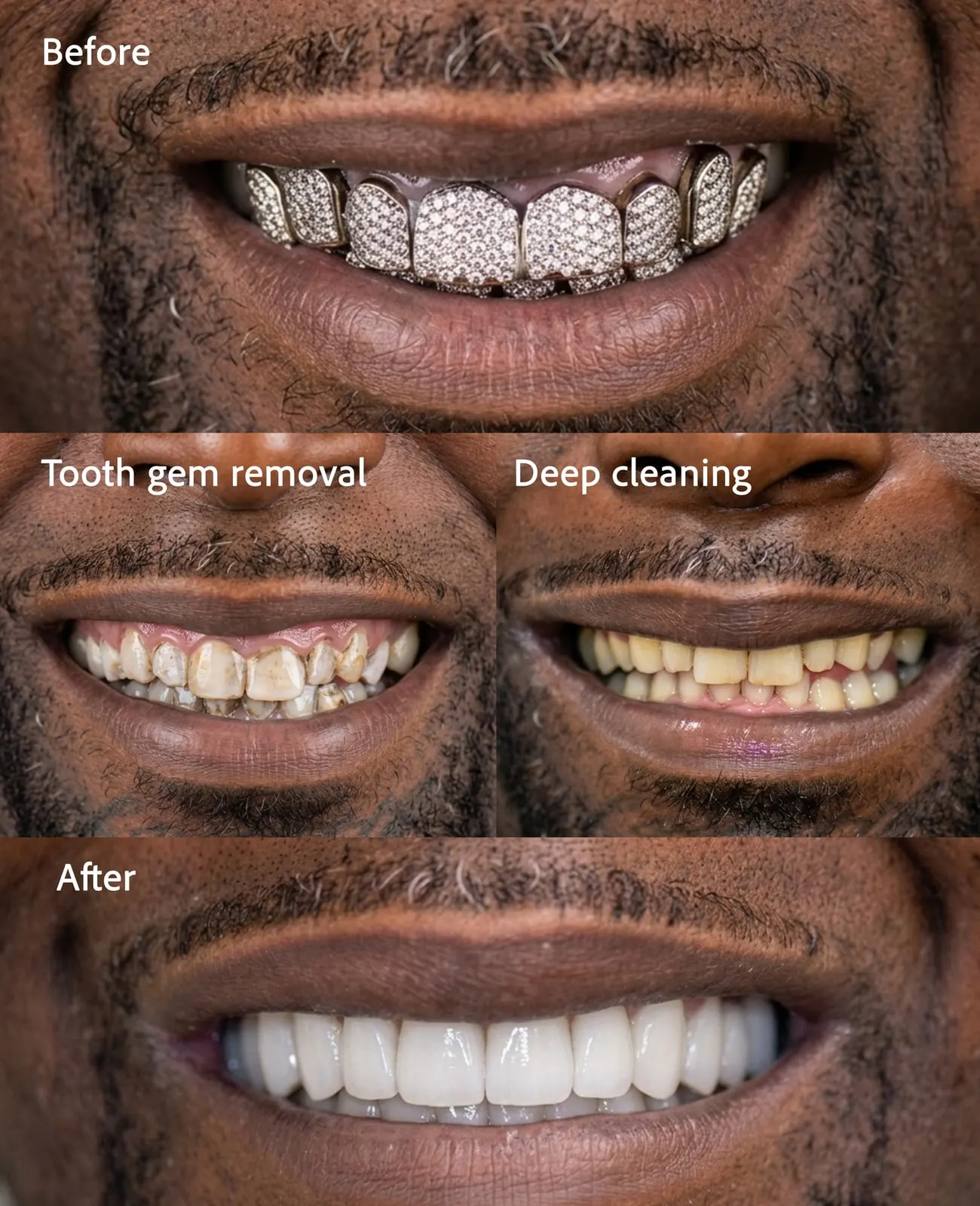 Before and after: tooth gem removal, deep cleaning and new smile, Xiluet patient, Miami