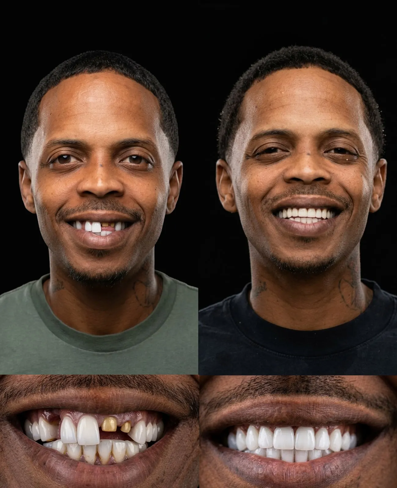 Before and after: missing and damaged front teeth restored, Xiluet patient, Miami