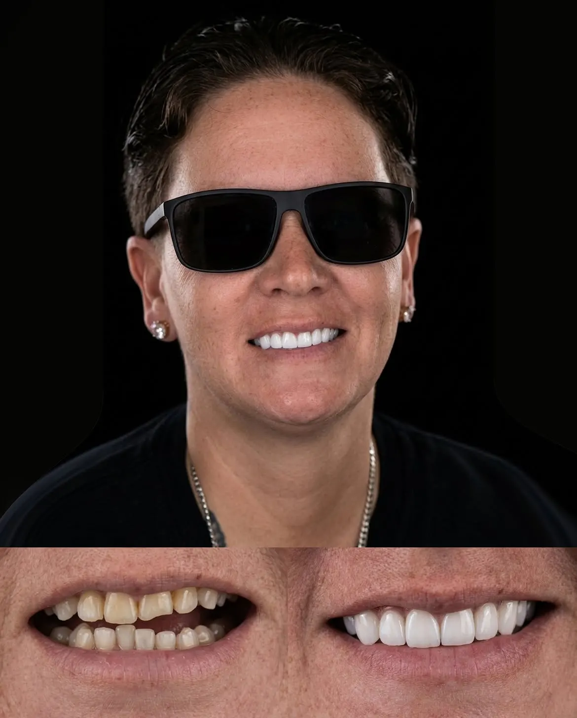 Before and after porcelain veneers, Xiluet patient, Miami