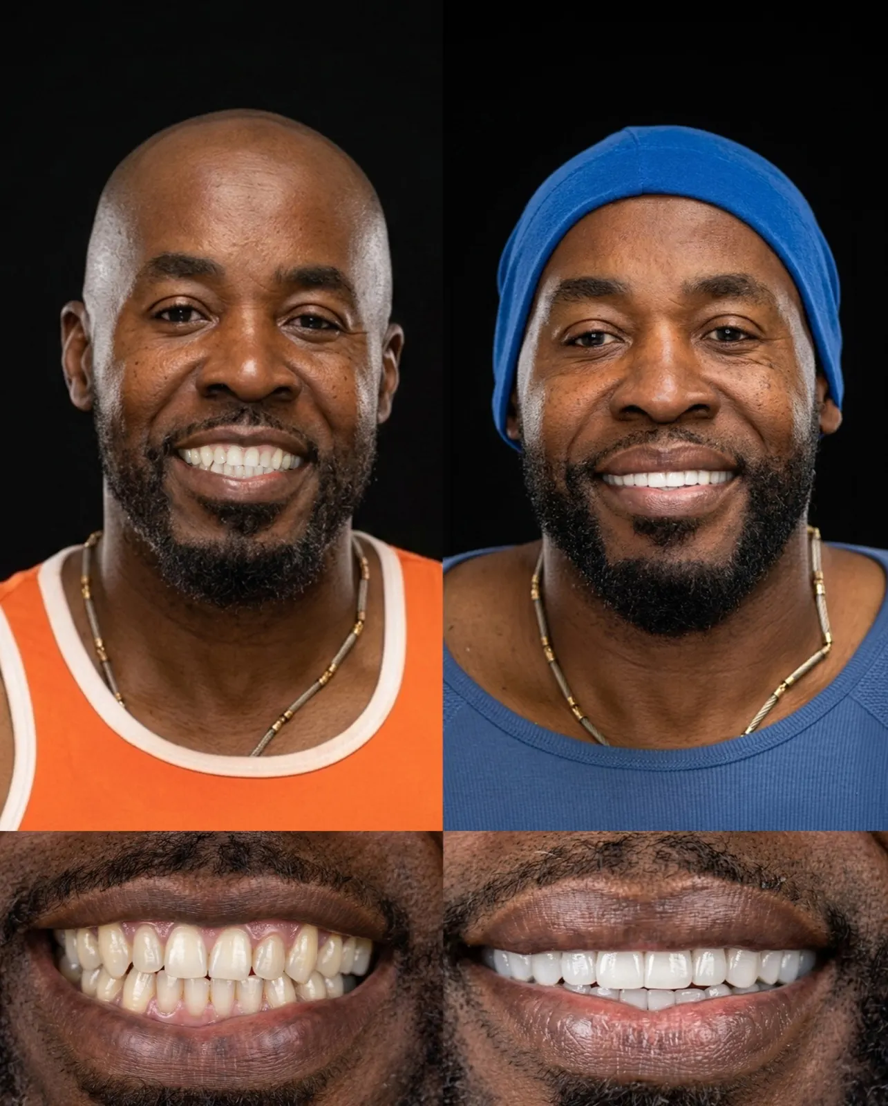 Before and after porcelain veneers, Xiluet patient with a beard, Miami