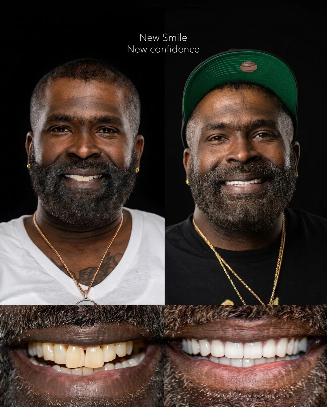 Before and after porcelain veneers replacing yellowed and uneven front teeth, Xiluet patient, Miami