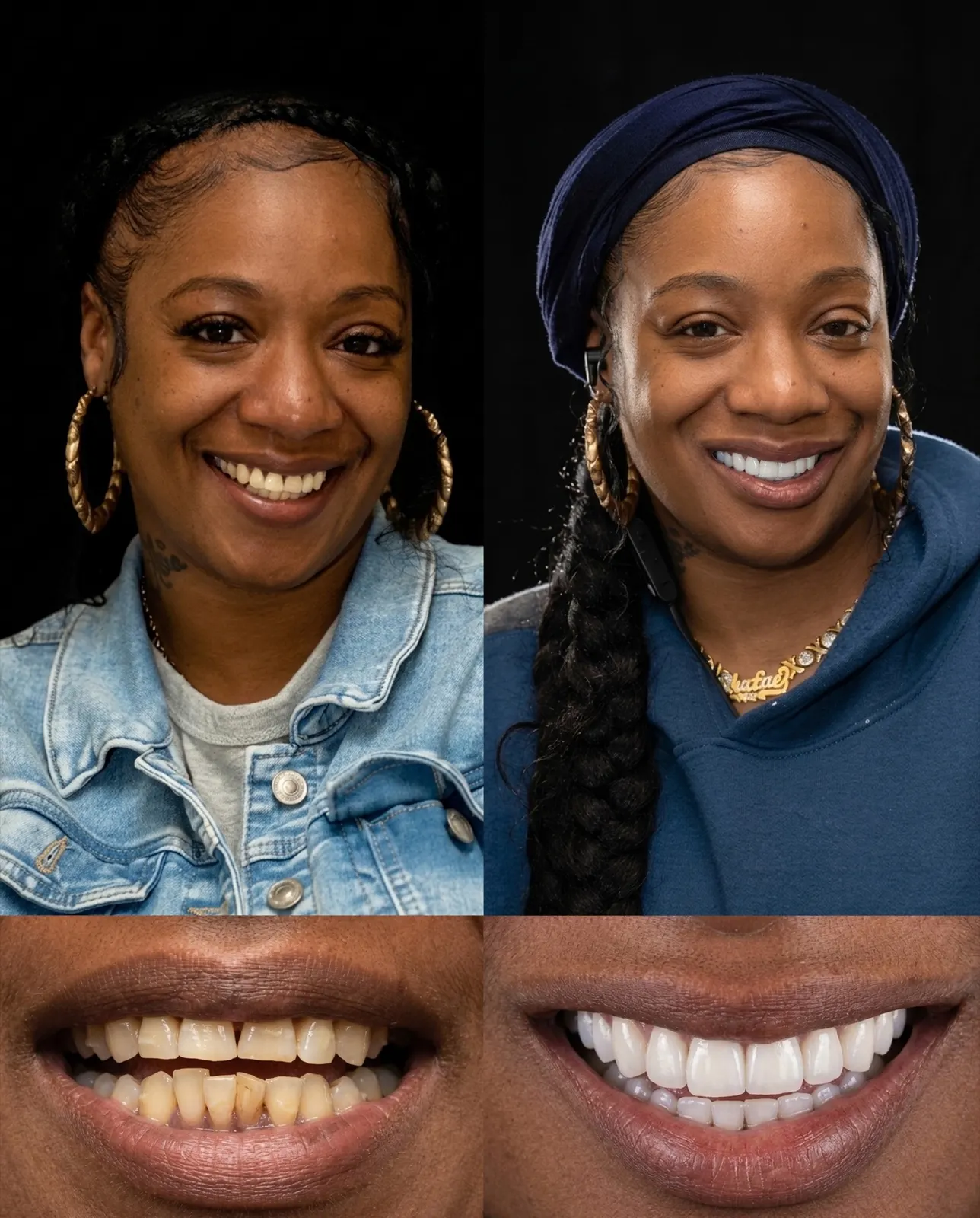 Before and after porcelain veneers brightening a stained smile, Xiluet patient, Miami