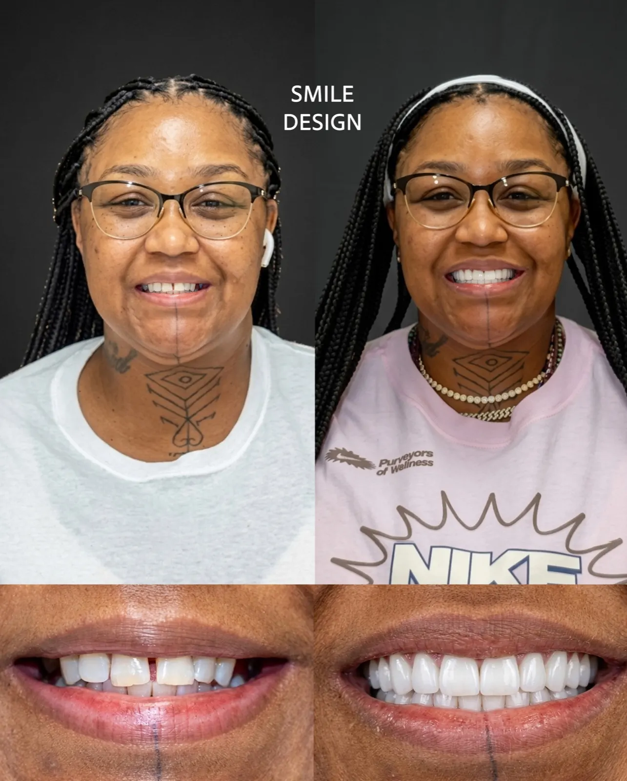 Before and after smile design with porcelain veneers, Xiluet patient, Miami
