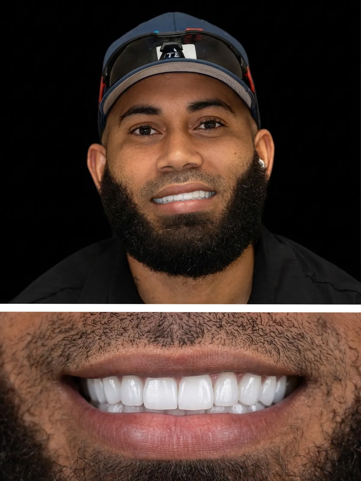 Porcelain veneers result, Xiluet patient with a beard smiling, Miami