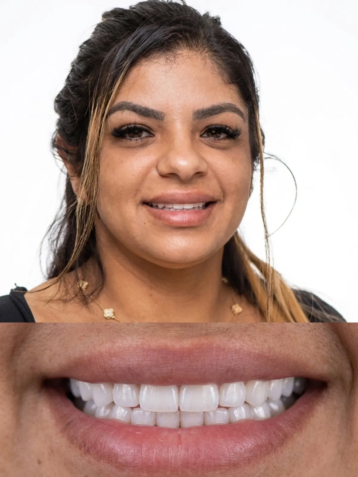 Porcelain veneers result, Xiluet patient smiling after treatment, Miami