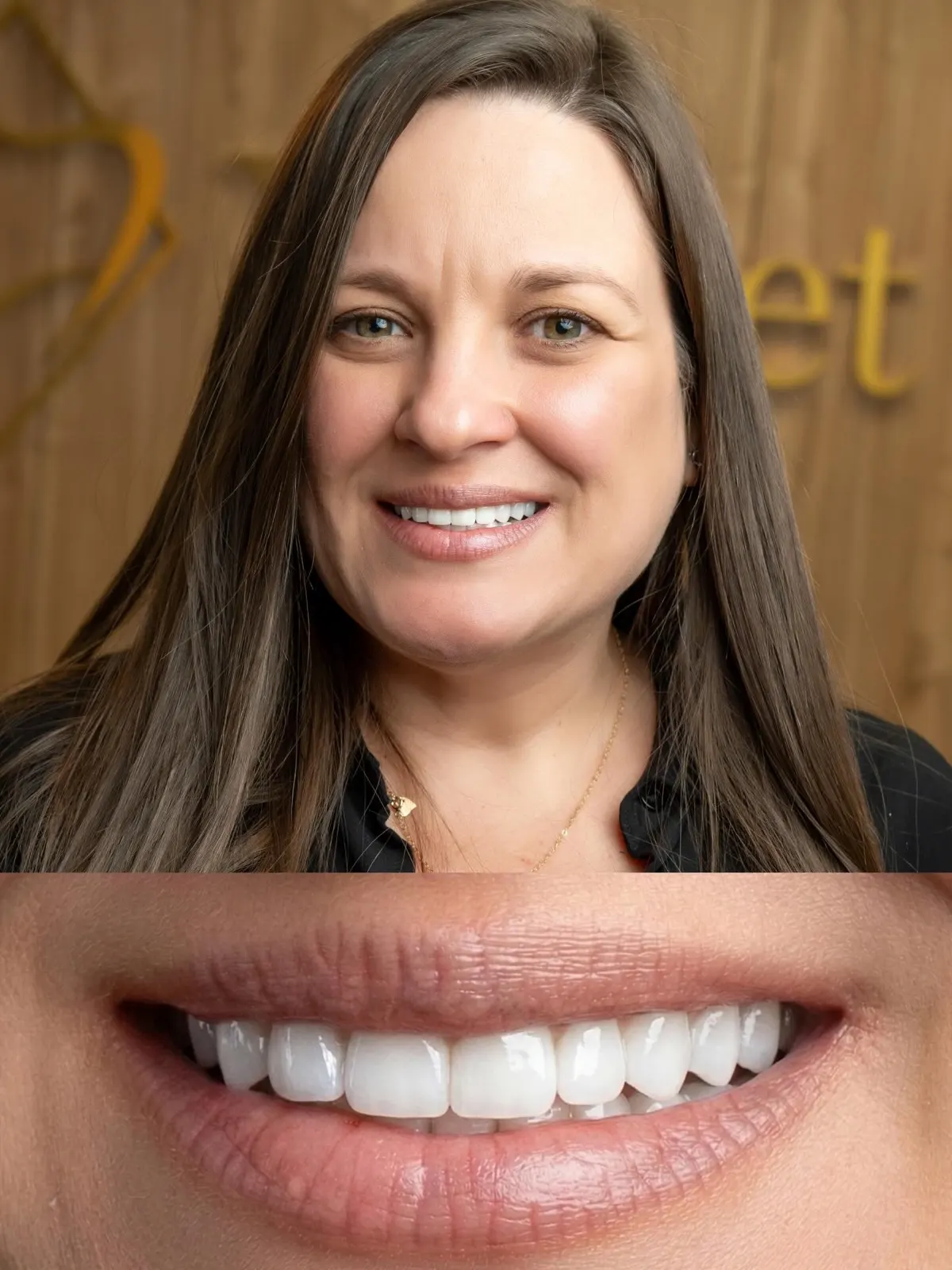 Resultado de carillas de porcelana, paciente de Xiluet sonriendo en la clínica, Miami