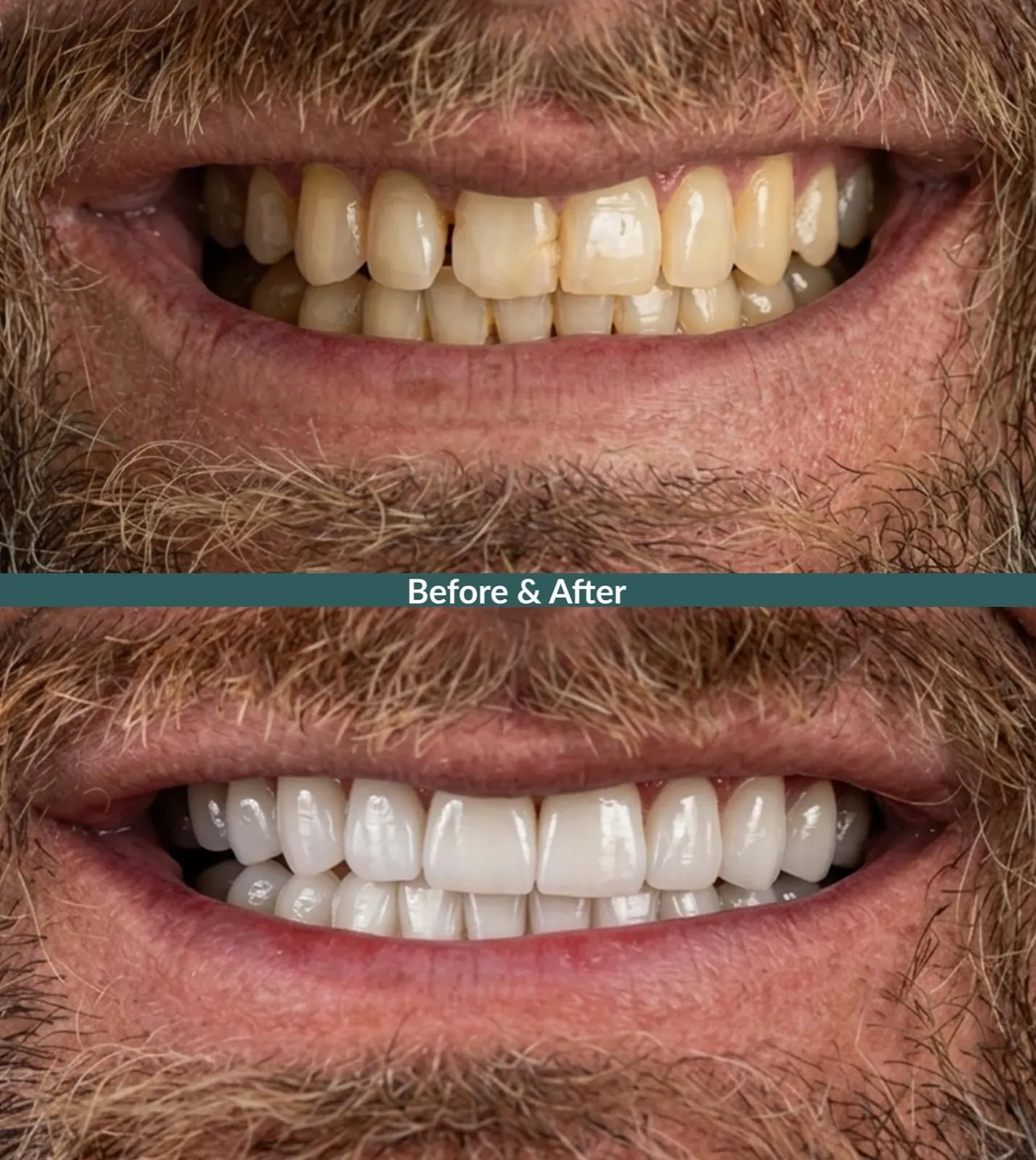 Antes y después de carillas de porcelana sobre dientes amarillentos, paciente de Xiluet con barba roja, Miami
