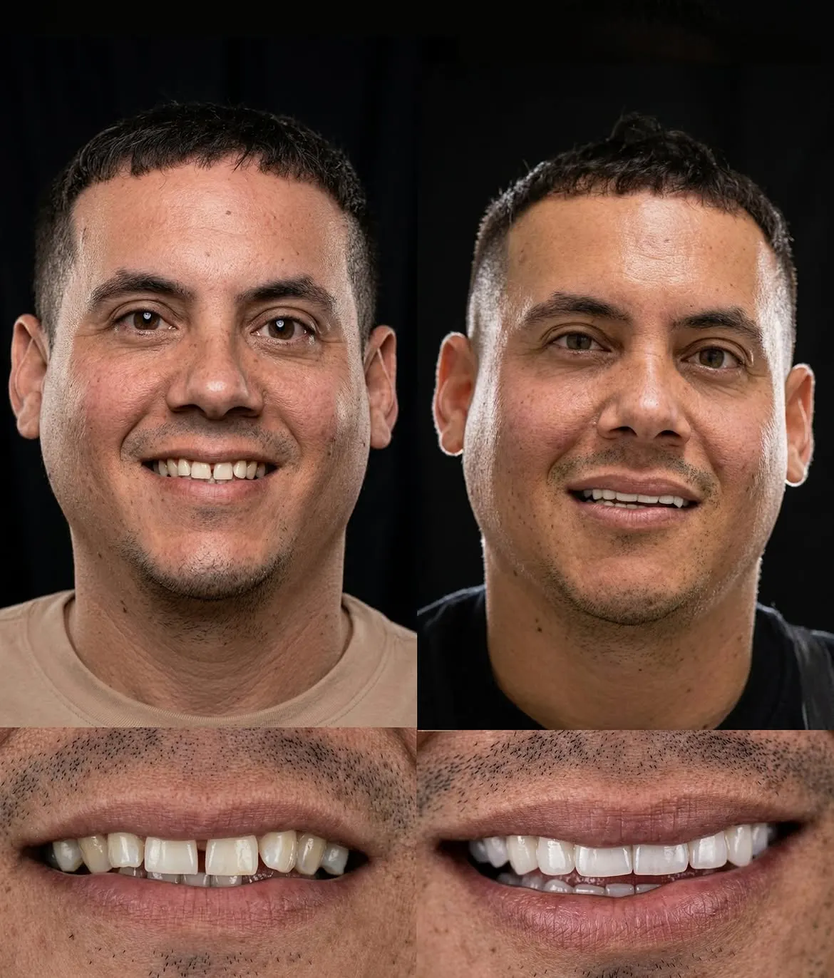 Before and after porcelain veneers, Xiluet patient, Miami