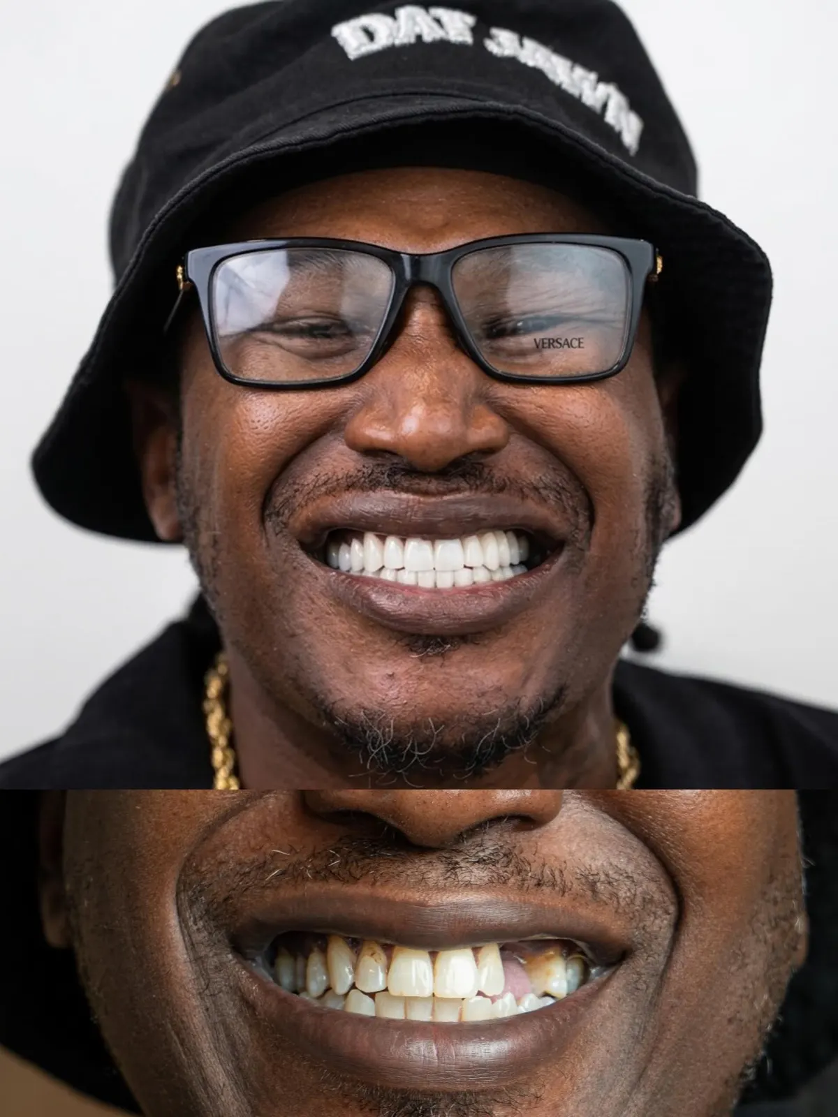 Before and after smile makeover restoring worn and stained teeth, Xiluet patient in a bucket hat, Miami