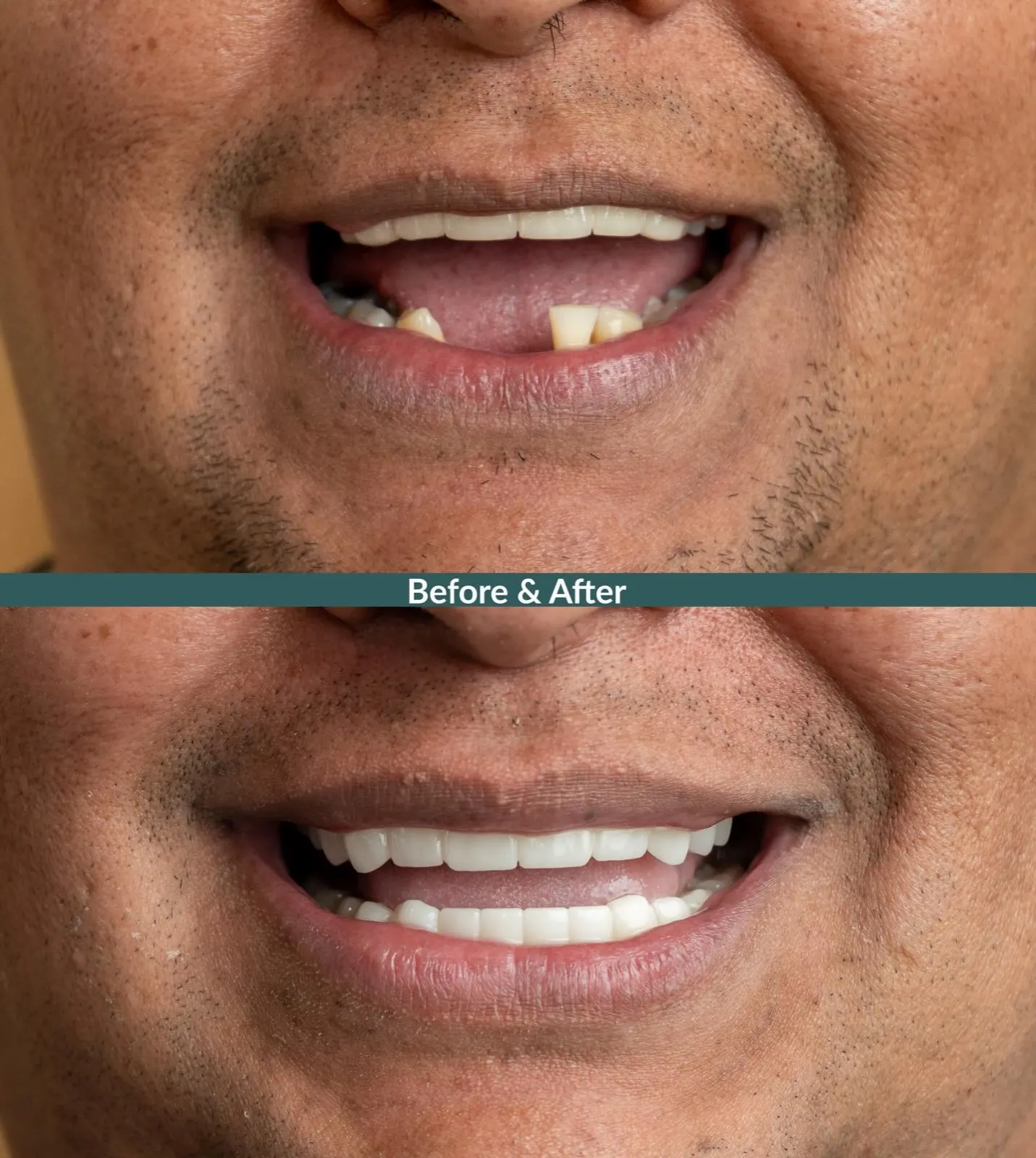 Before and after smile makeover replacing missing and worn teeth, Xiluet patient, Miami