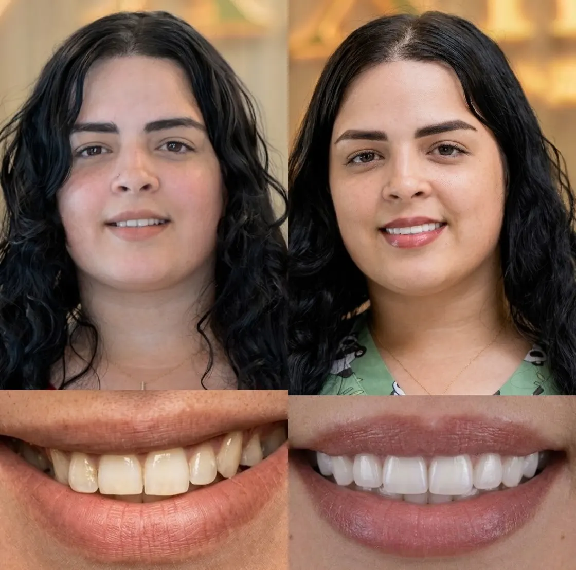 Before and after porcelain veneers on a young woman with dark curly hair, Xiluet patient, Miami