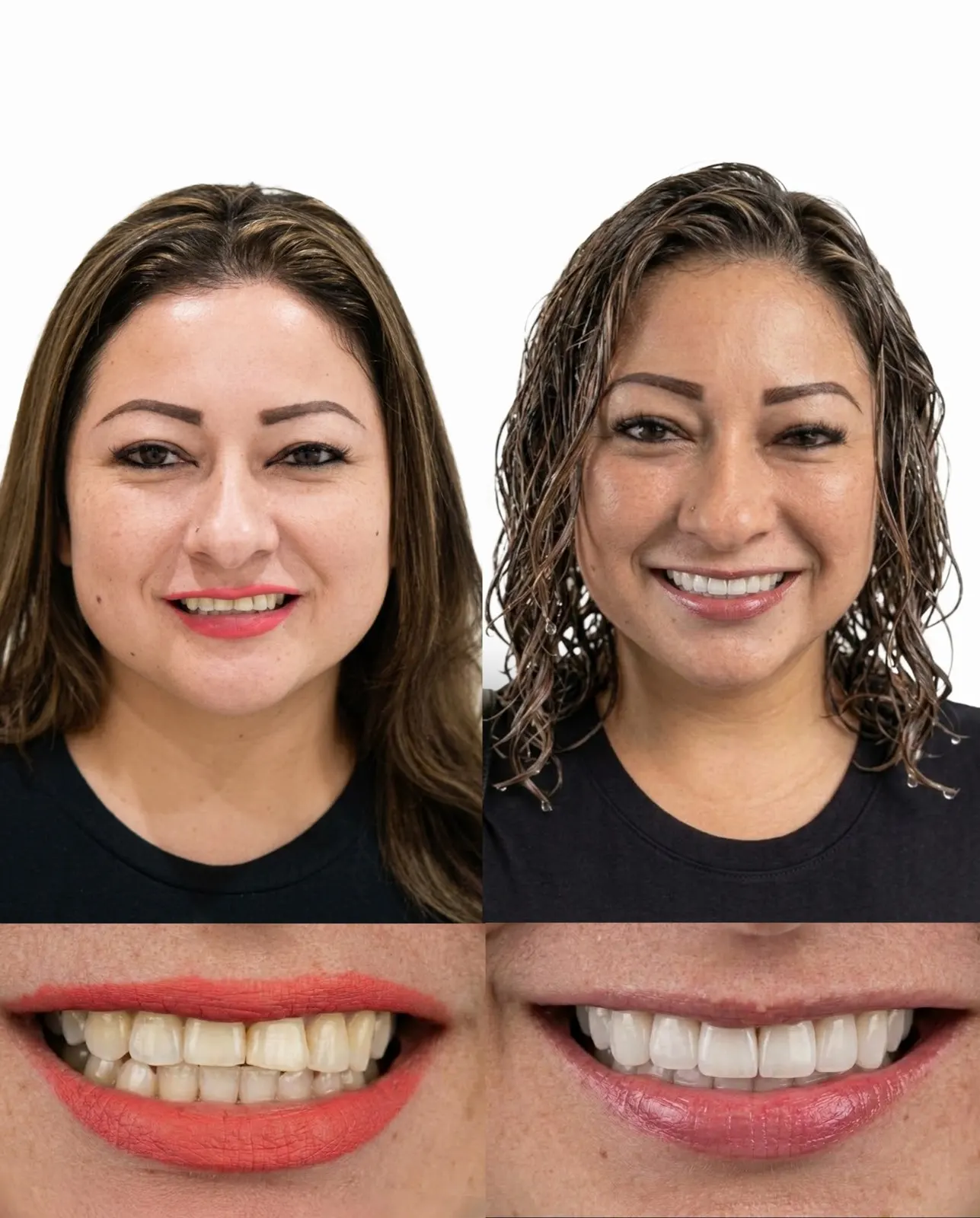 Before and after porcelain veneers brightening a worn, yellowed smile, Xiluet patient, Miami