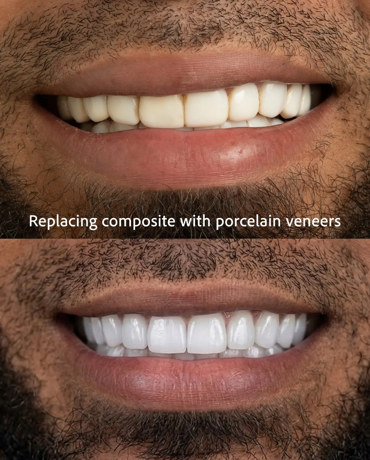 Before and after: composite veneers replaced with porcelain veneers, close-up of a bearded Xiluet patient, Miami