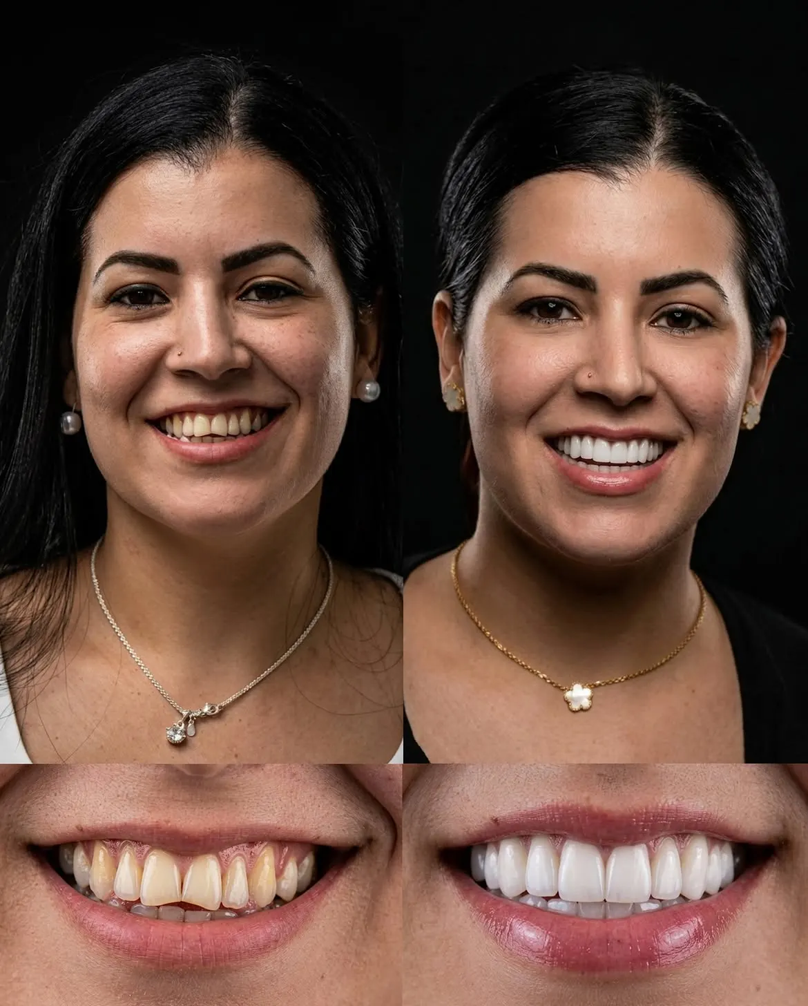 Before and after porcelain veneers, Xiluet patient, Miami