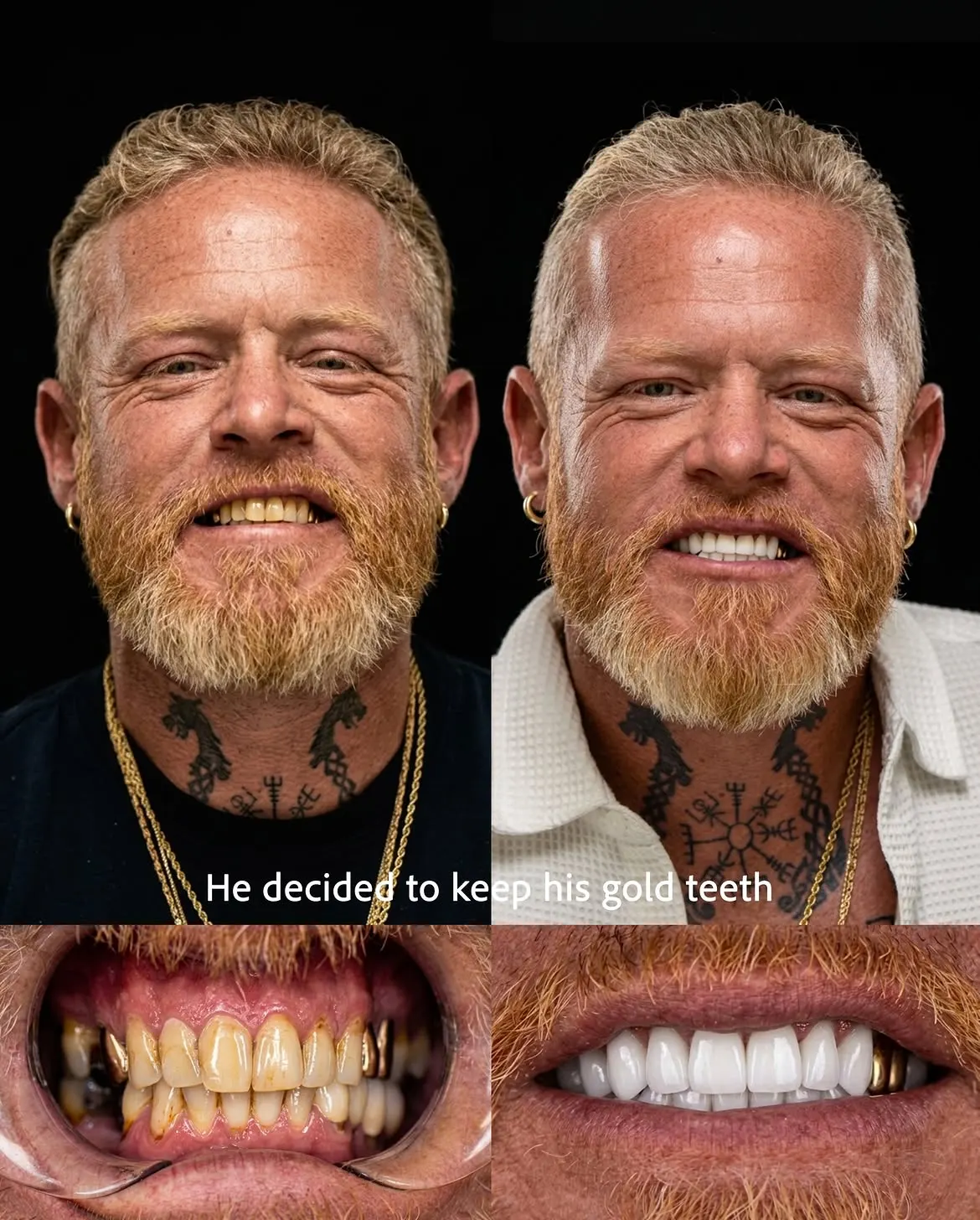 Before and after dental restorations, Xiluet patient, Miami