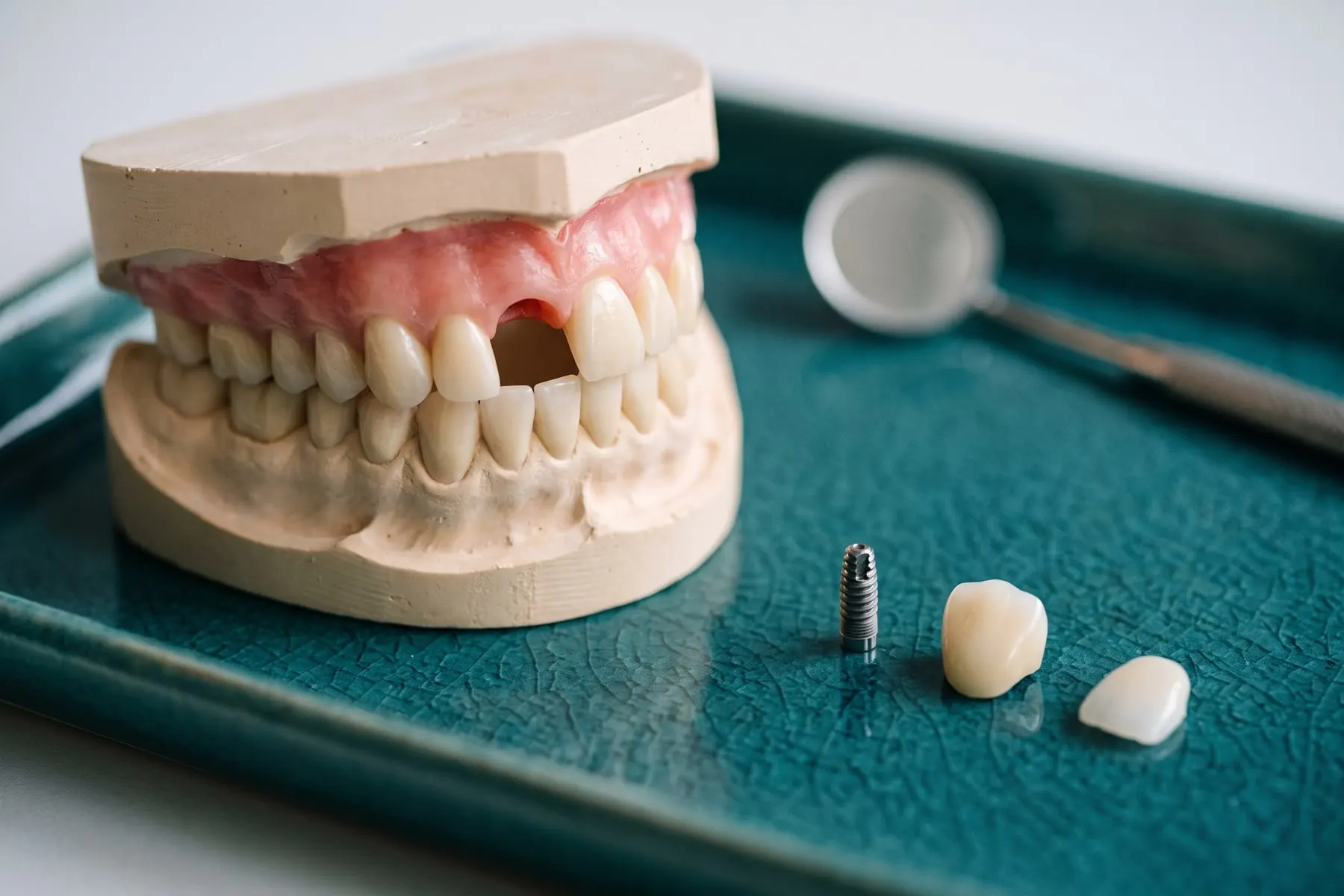 Un modelo dental con un diente frontal faltante junto a un implante de titanio, una corona de porcelana y una carilla de porcelana