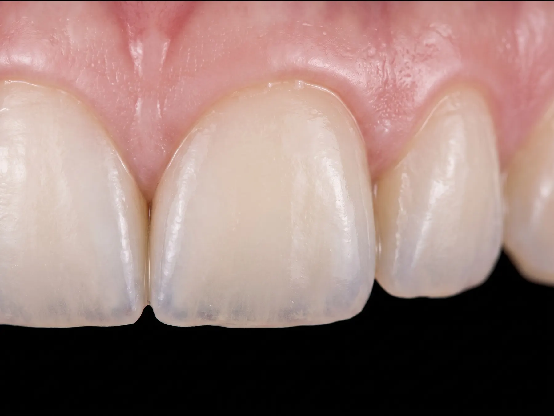 Close-up of a front tooth restored with a zirconia crown whose edge meets healthy pink gum with no dark line