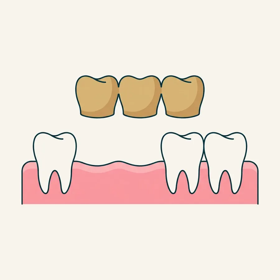 Ilustración de un puente dental de tres unidades sobre un diente ausente
