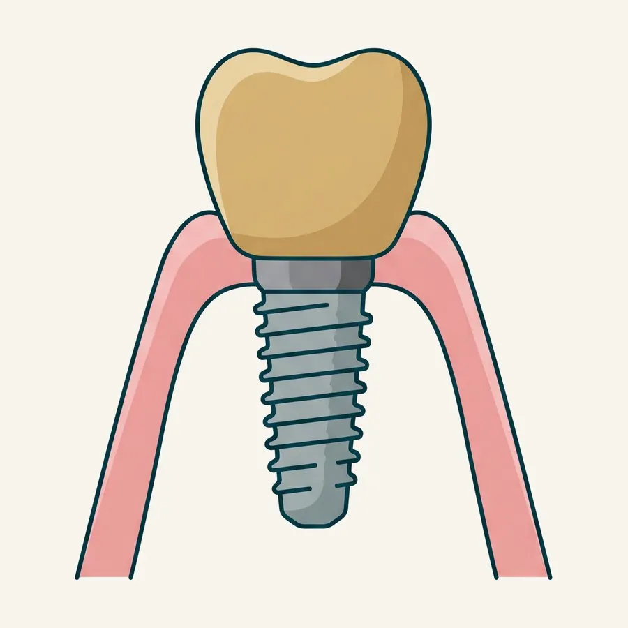 Ilustración de un implante dental en el hueso con una corona encima